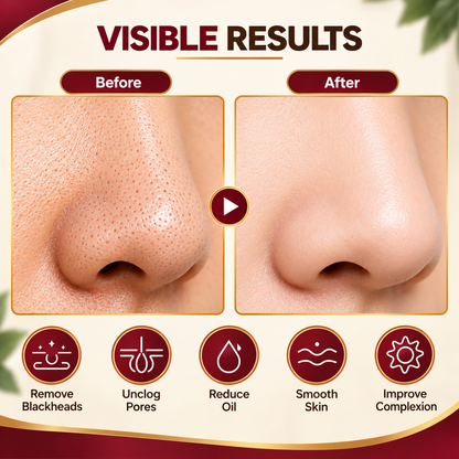 Blackhead Remover Vacuum Cleaner – Electric Pore Cleaner & Facial Deep Cleansing Device | The Smart Saman